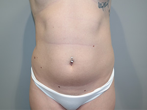 Liposuction Before and After 46 | Sanjay Grover MD FACS