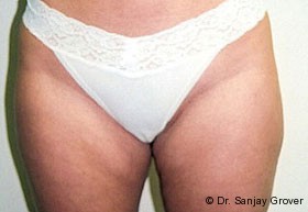 Liposuction Before and After | Sanjay Grover MD FACS