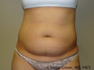 Liposuction Before and After 11 | Sanjay Grover MD FACS