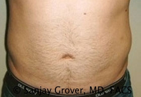 Liposuction Before and After | Sanjay Grover MD FACS