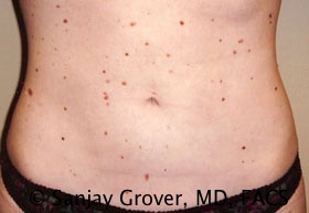 Liposuction Before and After | Sanjay Grover MD FACS