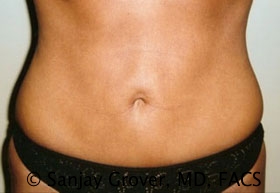 Liposuction Before and After | Sanjay Grover MD FACS