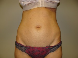 Liposuction Before and After 42 | Sanjay Grover MD FACS