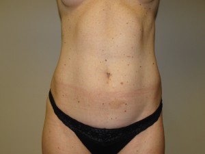 Liposuction Before and After 35 | Sanjay Grover MD FACS