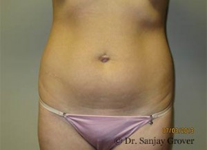 Liposuction Before and After 35 | Sanjay Grover MD FACS