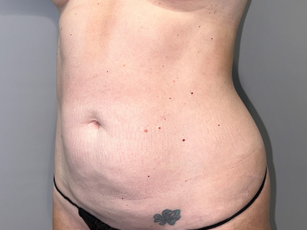 Tummy Tuck Before and After 01 | Sanjay Grover MD FACS