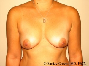 Breast Augmentation Before and After 25 | Sanjay Grover MD FACS