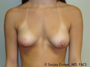 Breast Augmentation Before and After 02 | Sanjay Grover MD FACS