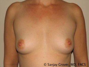 Breast Augmentation Before and After 255 | Sanjay Grover MD FACS