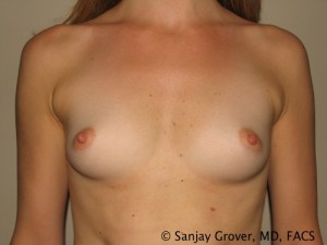 Breast Augmentation Before and After 86 | Sanjay Grover MD FACS