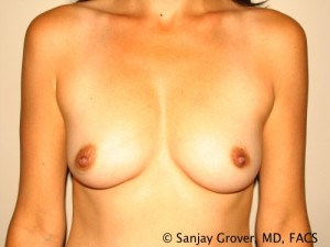 Breast Augmentation Before and After 86 | Sanjay Grover MD FACS