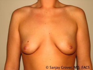 Breast Augmentation Before and After 97 | Sanjay Grover MD FACS