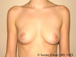 Breast Augmentation Before and After 02 | Sanjay Grover MD FACS