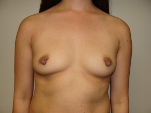 Breast Augmentation Before and After 164 | Sanjay Grover MD FACS