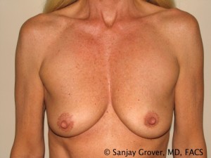 Breast Augmentation Before and After 288 | Sanjay Grover MD FACS