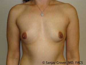 Breast Augmentation Before and After 250 | Sanjay Grover MD FACS