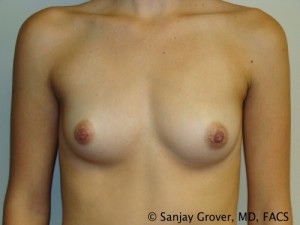 Breast Augmentation Before and After 01 | Sanjay Grover MD FACS