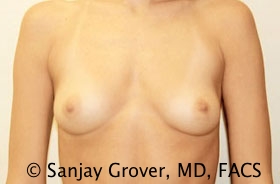 Breast Augmentation Before and After 01 | Sanjay Grover MD FACS