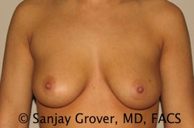 Breast Augmentation Before and After 97 | Sanjay Grover MD FACS