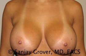 Breast Augmentation Before and After | Sanjay Grover MD FACS