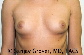 Breast Augmentation Before and After 164 | Sanjay Grover MD FACS