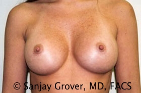 Breast Augmentation Before and After | Sanjay Grover MD FACS