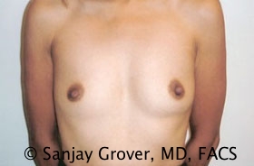 Breast Augmentation Before and After 288 | Sanjay Grover MD FACS