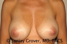 Breast Augmentation Before and After | Sanjay Grover MD FACS