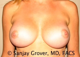 Breast Augmentation Before and After | Sanjay Grover MD FACS