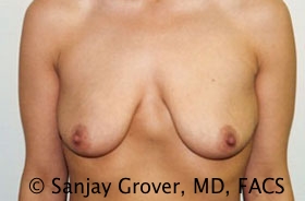 Breast Augmentation Before and After 255 | Sanjay Grover MD FACS