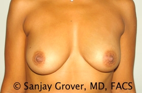 Breast Augmentation Before and After 176 | Sanjay Grover MD FACS