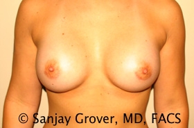 Breast Augmentation Before and After | Sanjay Grover MD FACS