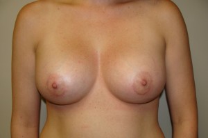 Breast Augmentation Before and After 191 | Sanjay Grover MD FACS