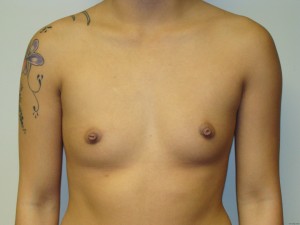 Breast Augmentation Before and After 191 | Sanjay Grover MD FACS