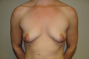 Breast Augmentation Before and After 176 | Sanjay Grover MD FACS