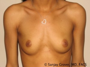 Breast Augmentation Before and After 220 | Sanjay Grover MD FACS