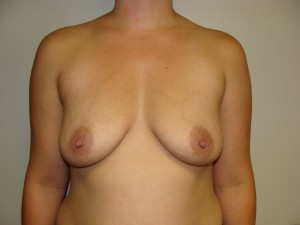 Breast Augmentation Before and After 191 | Sanjay Grover MD FACS