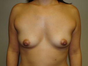 Breast Augmentation Before and After 288 | Sanjay Grover MD FACS