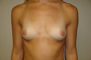 Breast Augmentation Before and After 250 | Sanjay Grover MD FACS