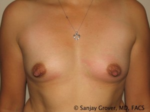 Breast Augmentation Before and After 255 | Sanjay Grover MD FACS