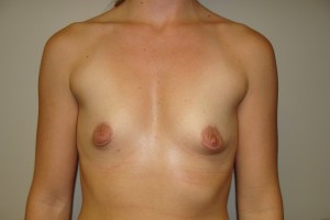 Breast Augmentation Before and After 220 | Sanjay Grover MD FACS