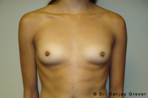 Breast Augmentation Before and After 86 | Sanjay Grover MD FACS