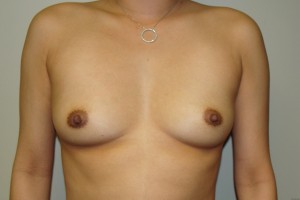 Breast Augmentation Before and After 250 | Sanjay Grover MD FACS