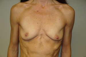 Breast Augmentation Before and After 01 | Sanjay Grover MD FACS