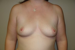 Breast Augmentation Before and After 14 | Sanjay Grover MD FACS