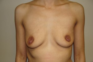 Breast Augmentation Before and After 02 | Sanjay Grover MD FACS