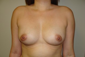 Breast Augmentation Before and After 164 | Sanjay Grover MD FACS
