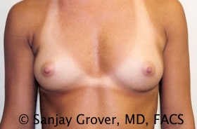 Breast Augmentation Before and After 288 | Sanjay Grover MD FACS