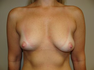 Breast Augmentation Before and After 288 | Sanjay Grover MD FACS