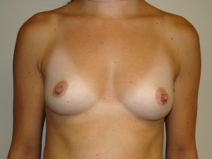 Breast Augmentation Before and After 176 | Sanjay Grover MD FACS